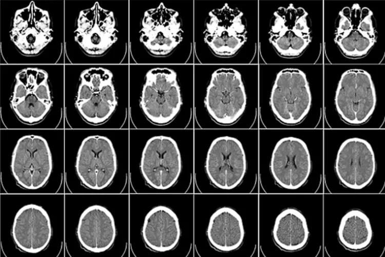 Tomografía cerebral arroja luz sobre trastorno de atención en menores