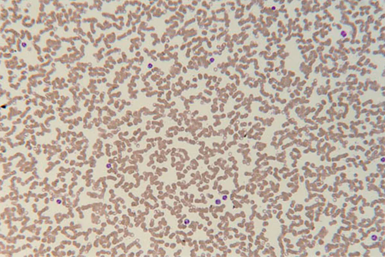En la segunda década del siglo pasado, una extraña epidemia sacudió al mundo. El mal, que atacaba al cerebro y dejaba a la gente como estatuas, sin poder hablar o moverse, mató a cerca de un millón de personas. La enfermedad se llamó encefalitis letárgica, pero su origen no pudo ser determinado y se convirtió en uno de los grandes misterios de la medicina moderna.