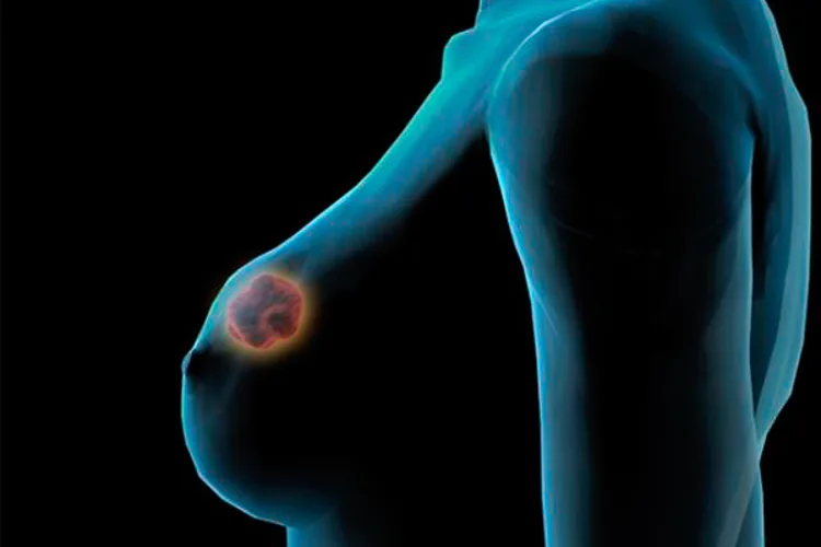 Programa para predecir cáncer de mamas