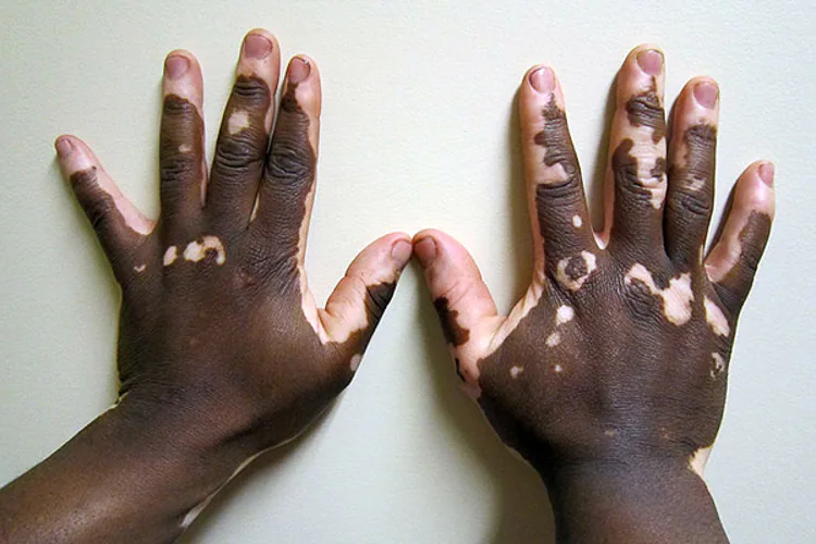 El vitiligo tiene cura.