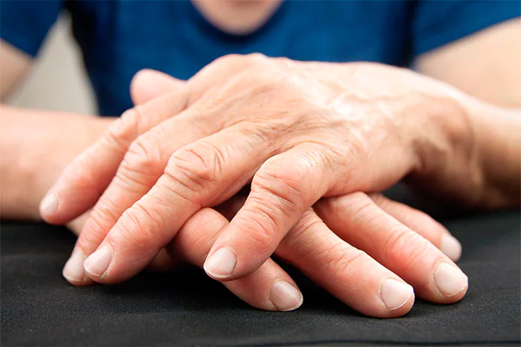 La artritis reumatoide tiene su origen en la flora intestinal