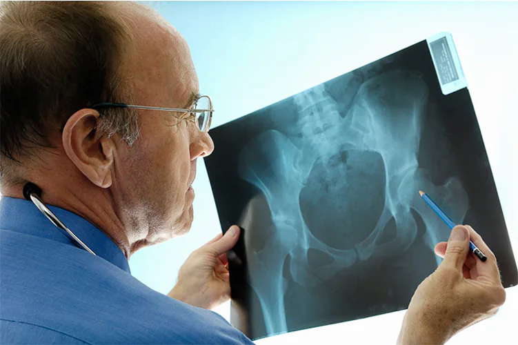 El densitómetro del Peset predice el riesgo de fracturas osteoporóticas