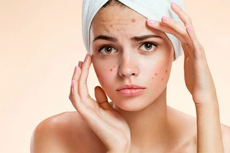 Mitos sobre el acné